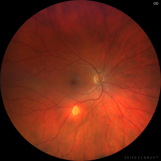 Figure 1: Fundus photography of the right eye showing a yellow-orange lesion inferior to the inferior arcade. Atrophy can be seen at the apex of the lesion