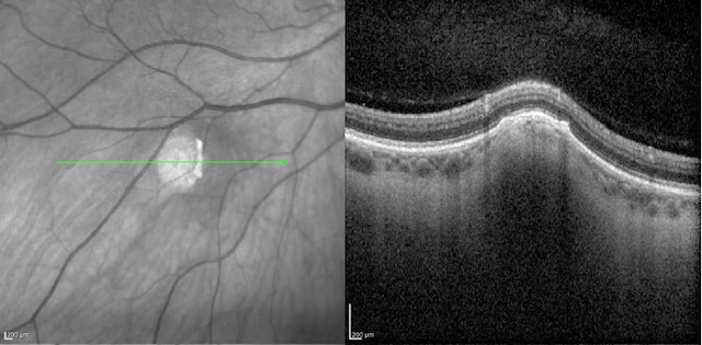 Figure 2: OCT macula of the right eye showing elevation of the lesion as well as mild subretinal high-reflective material over the apex. There was no subretinal fluid. The lesion appears to originate from the sclera, compressing the choroid above it. 