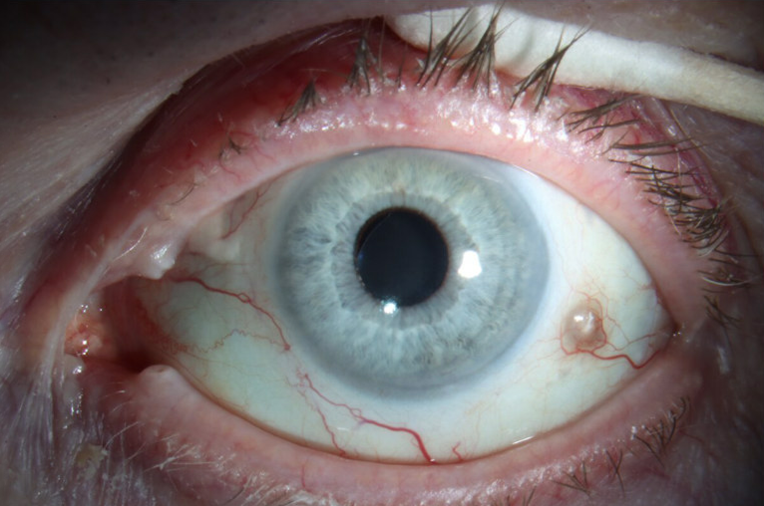 Inferotemporal lens dislocation with exposed Gore-Tex suture