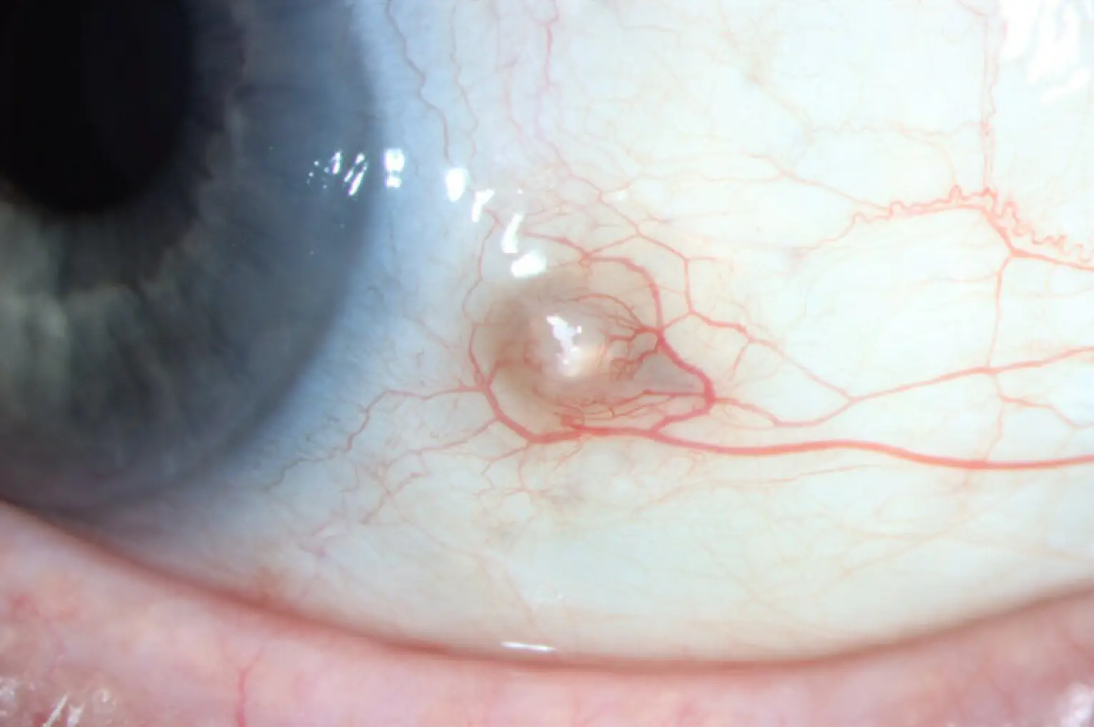 Exposed Gore-Tex suture