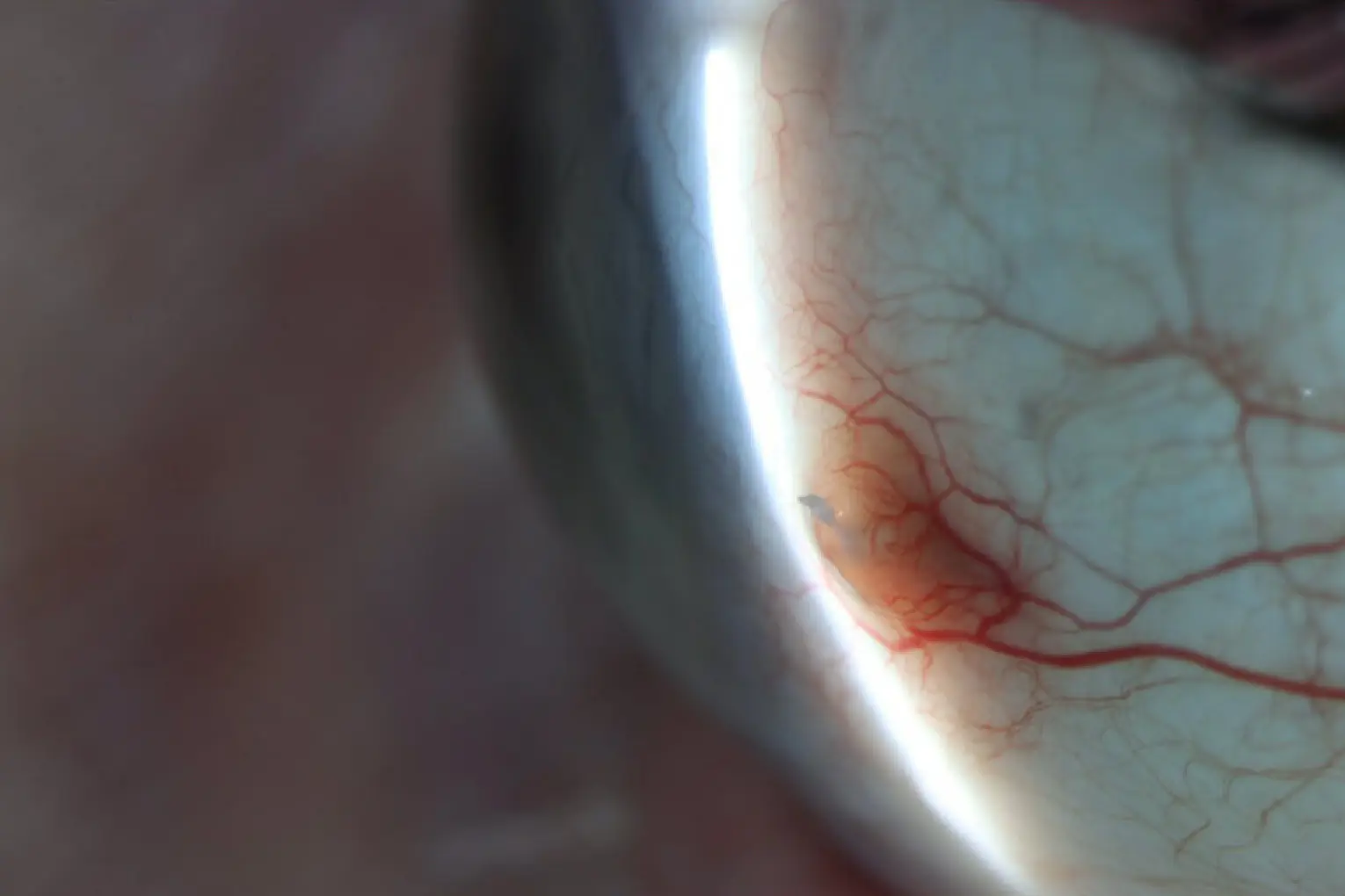 Exposed Gore-Tex suture