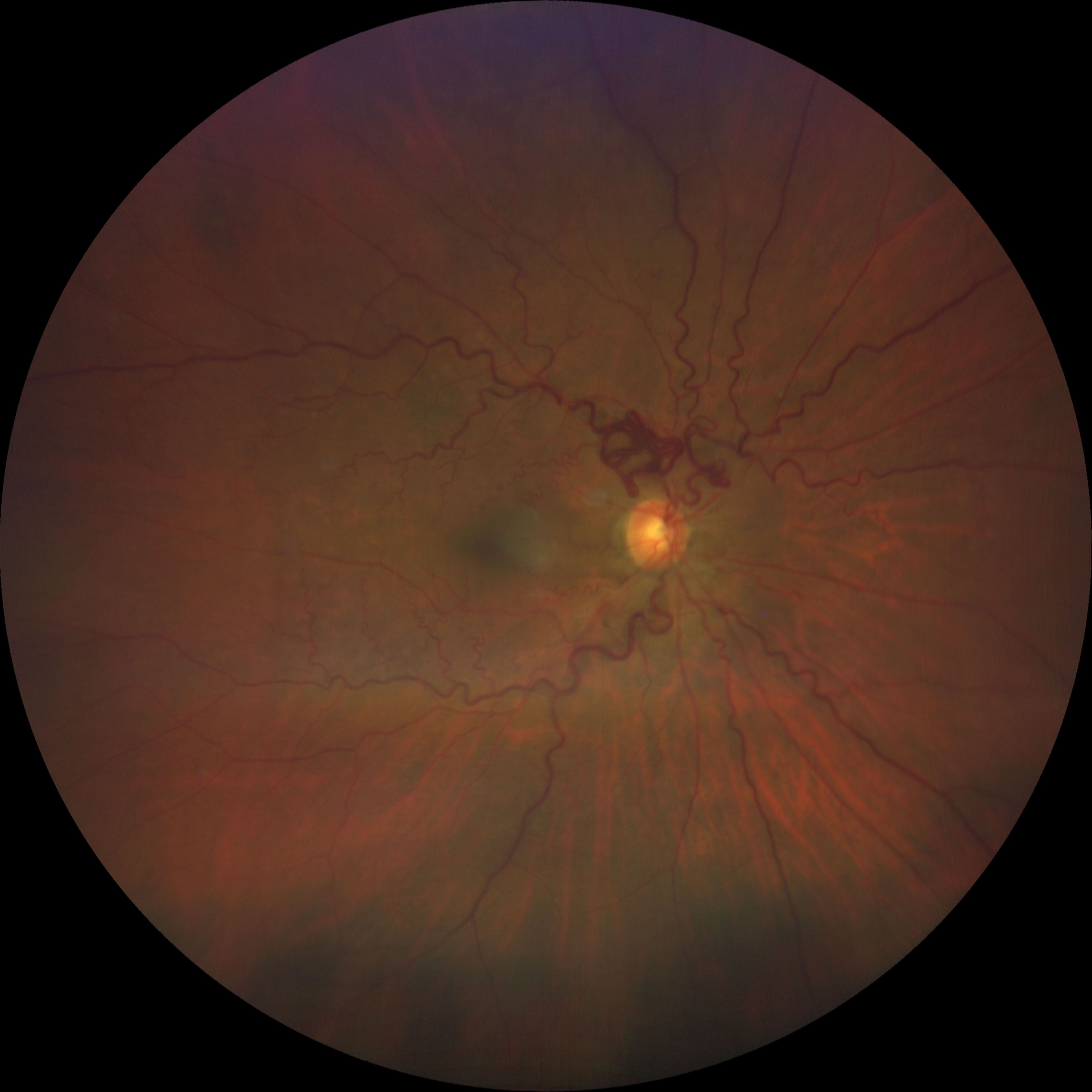  right eye fundus photo showing a large arterial venous malformation with severe tortuosity at the superior arcade and moderate tortuosity at the inferior arcade OD