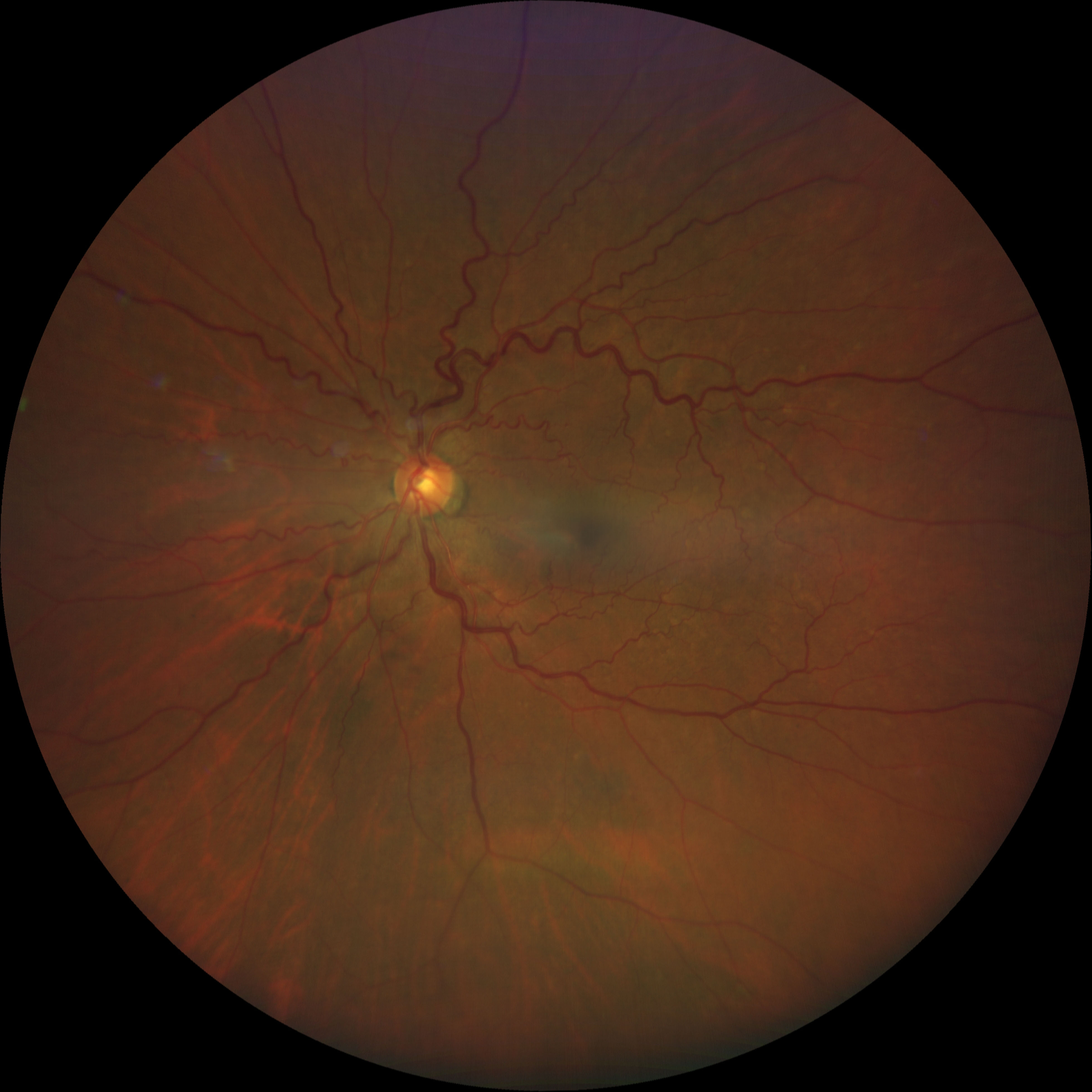 left eye fundus photo showing moderately dilated and tortuous retinal vasculature