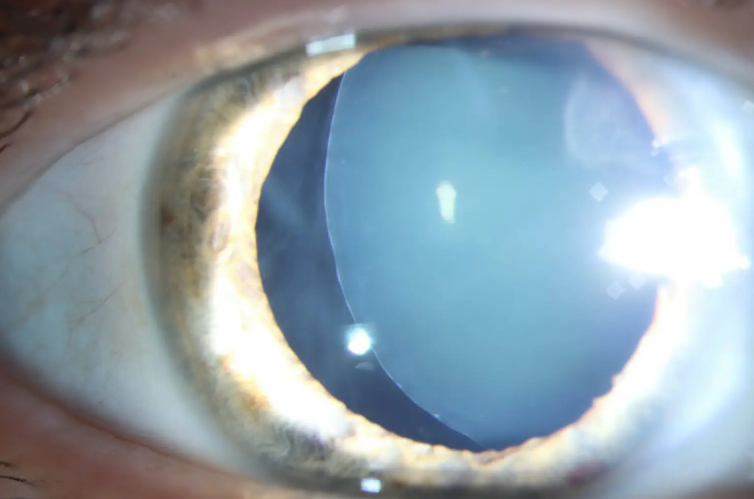 Superonasal crystalline lens subluxation with absent zonules