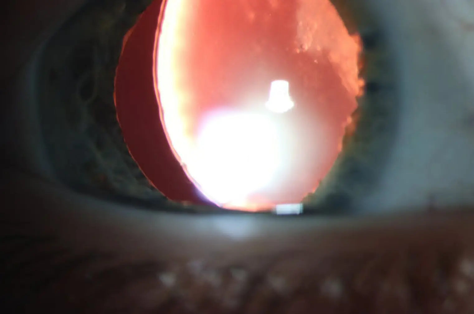 Superonasal subluxation of crystalline lens with absent zonules and posterior subcapsular cataract
