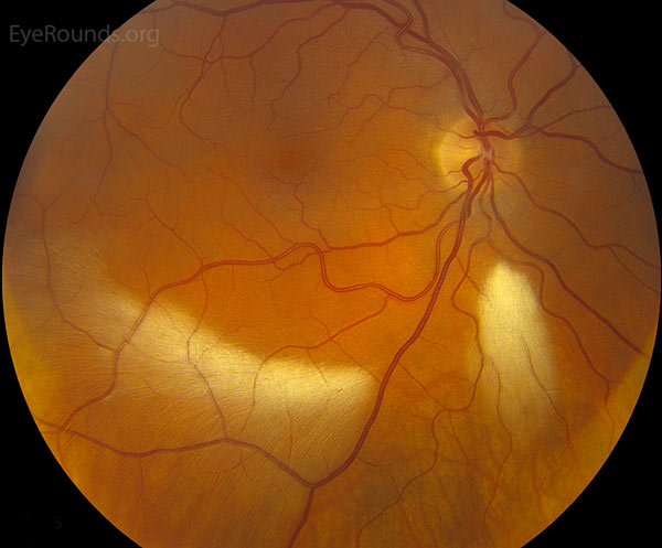 Myelinated nerve fiber layer with visual field defect