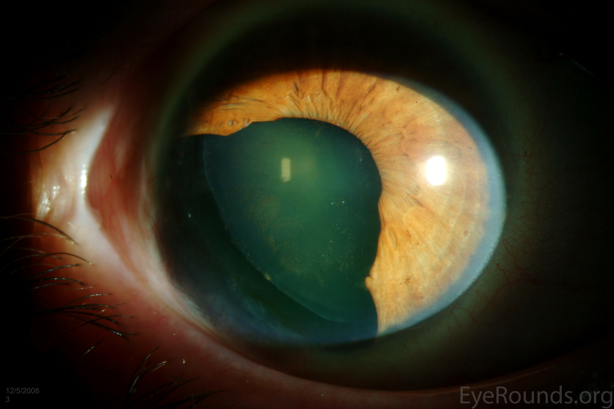 large iris defect after resection of an iris melanoma pre-op