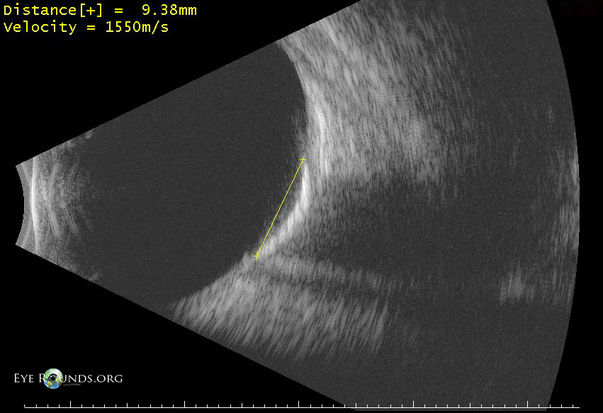 A-scan image choroidal osteoma 