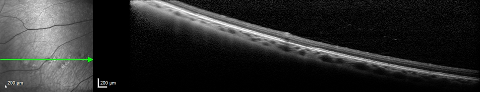 oct of polar bear tracks, congenital albinotic spots of the retinal pigmented epithelium (CASRPE) 