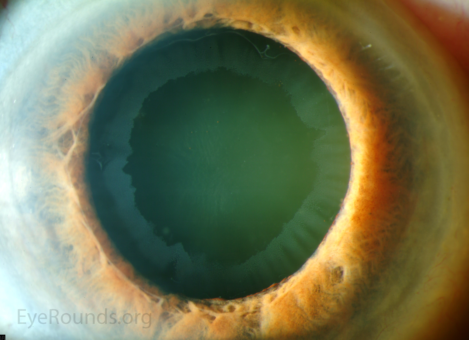 Exfoliative material on the pupillary margin and anterior lens capsule
