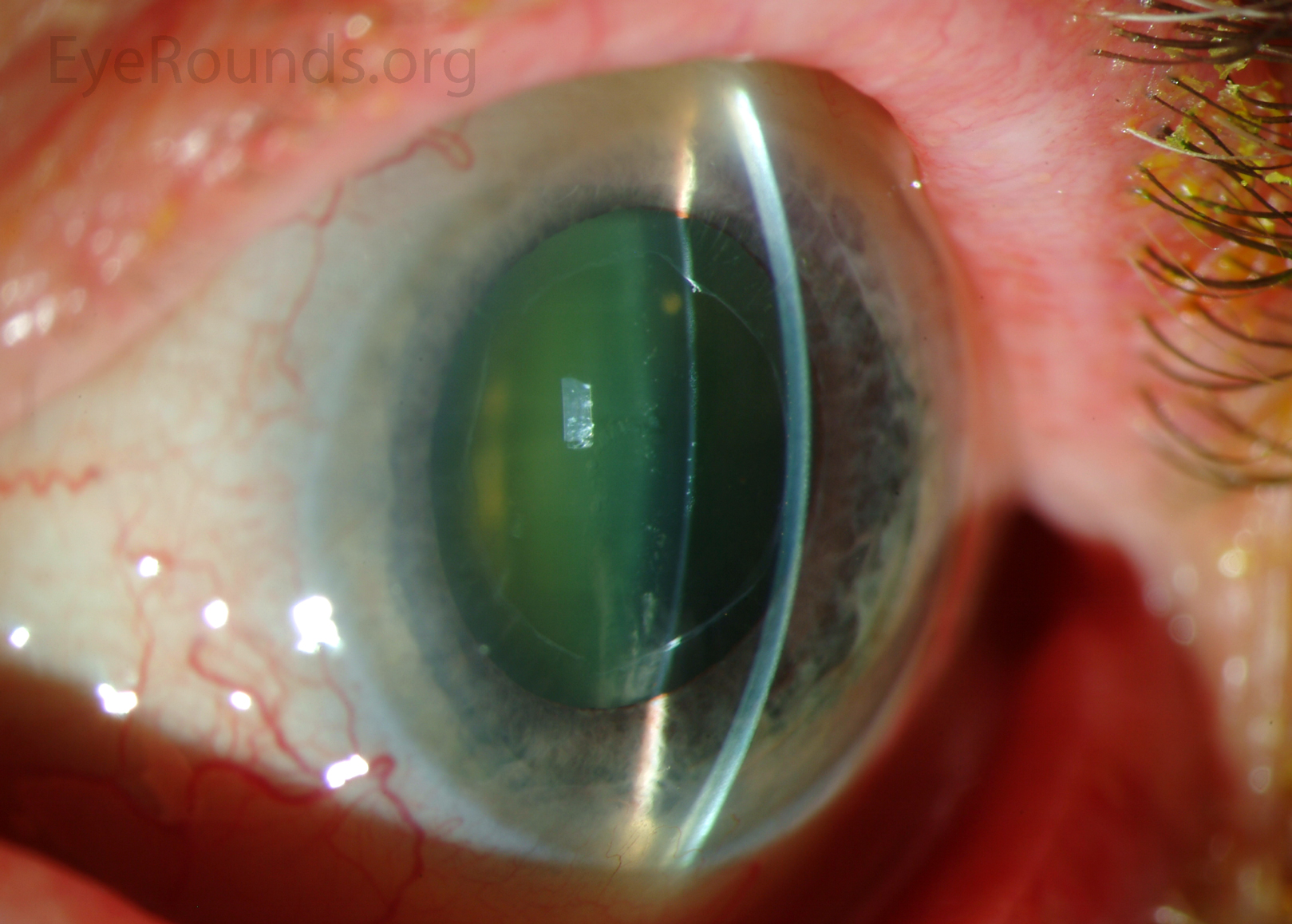 Exfoliative material on the pupillary margin and anterior lens capsule - slit lamp