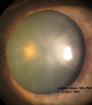  Exfoliative material on an undilated pupillary margin
