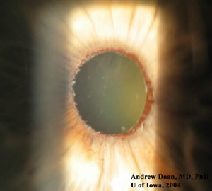  Exfoliative material on an undilated pupillary margin