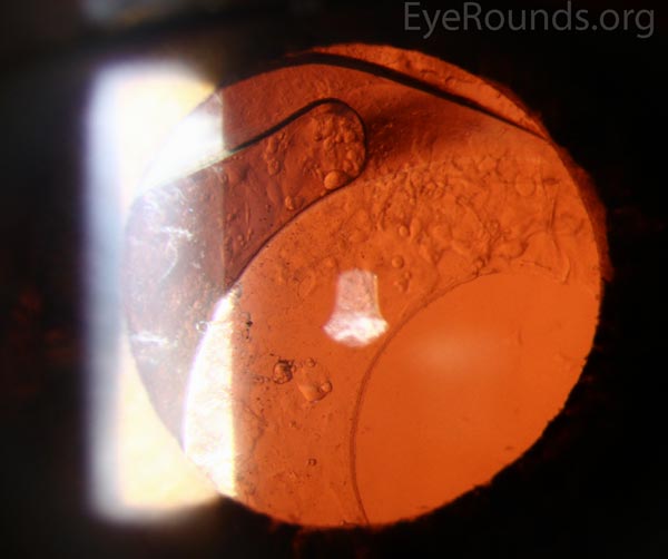 Pseudoexfoliation syndrome