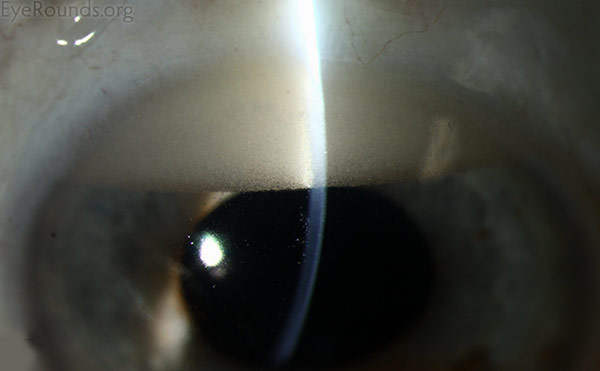 reverse hypopyon high magnification - slit lamp