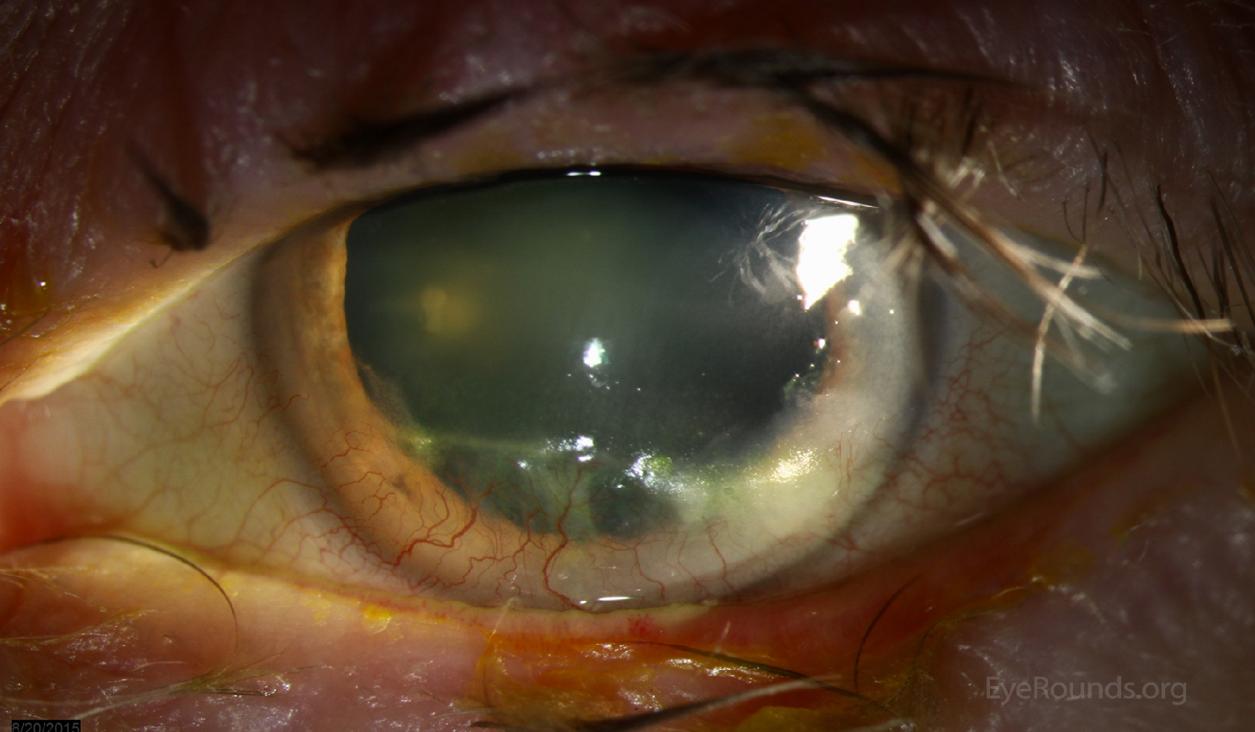 Bilateral rosacea keratitis with inferior pannus formation and Salzmann-like changes OD