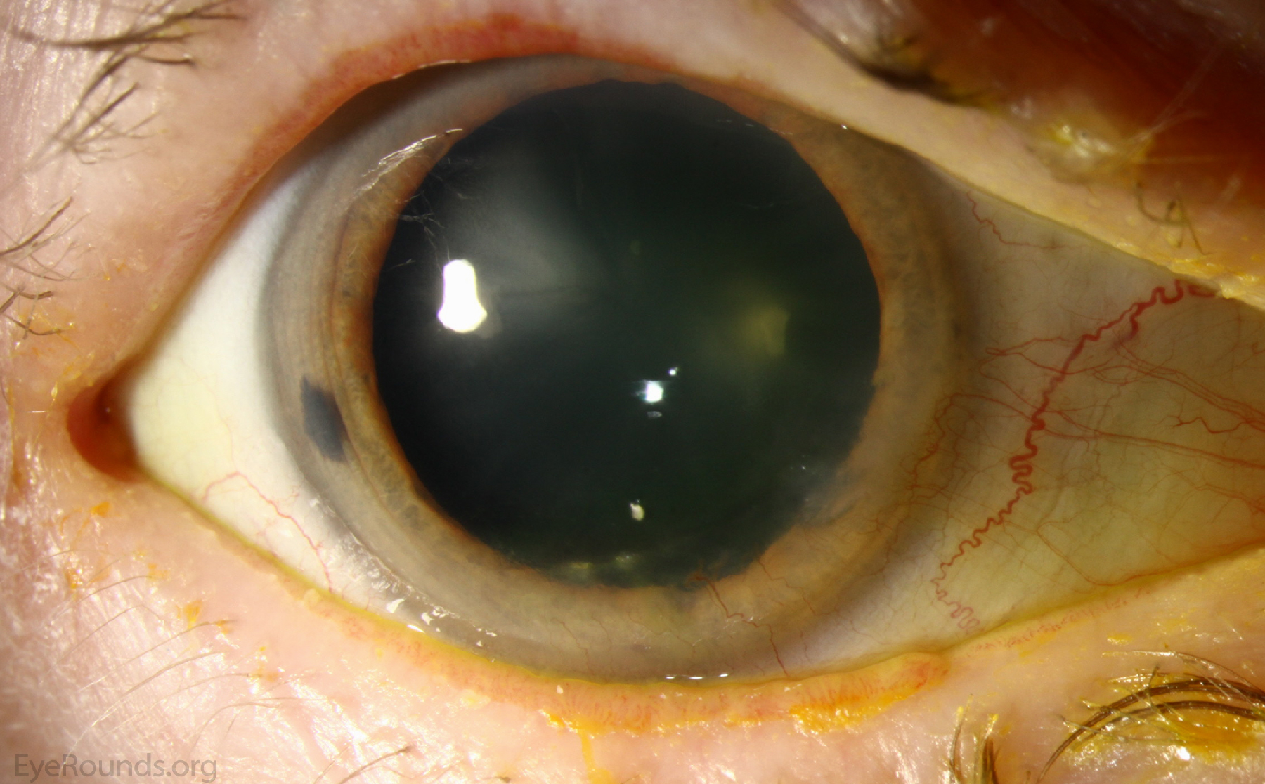 Bilateral rosacea keratitis with inferior pannus formation and Salzmann-like changes OS