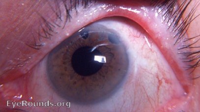 perfect intracapsular cataract operation with two peripheral iridectomies - a part of cataract surgery's history