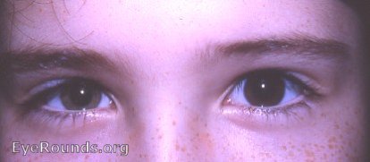 Heterochromia with Horner's syndrome. Normal OS is brown