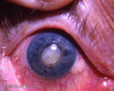 intumescent cataracta complicat secondary to anterior uveitis OD