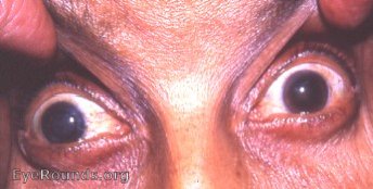 mature corticonuclear cataract with patchy heterochromia iridis OD