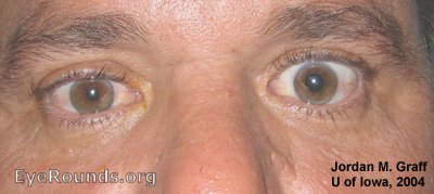 Horner's pupil as accentuated after administration of topical cocaine