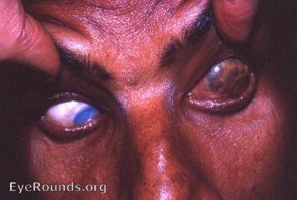 Staphyloma: huge anterior scleral staphyloma