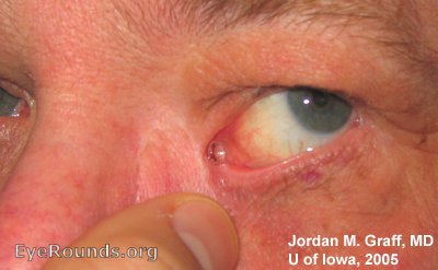 Jones tube in  patient, tumor removal resulted in irreparable damage to the lacrimal system