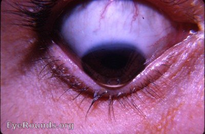 cornea: keratoconus with apical scarring