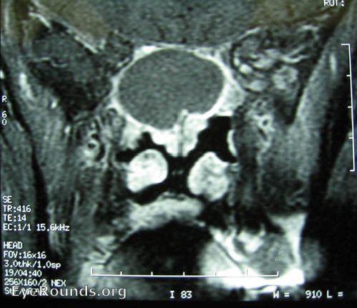 MRI scans showing sphenoid sinus mucocele.