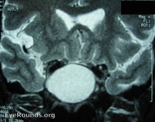 MRI scans showing sphenoid sinus mucocele.