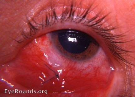 Postop McReynold's procedure for pterygium