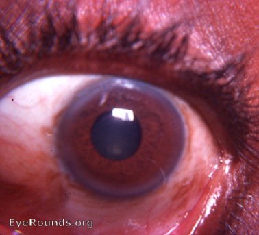 Healed McReynold's pterygium transplantation operation