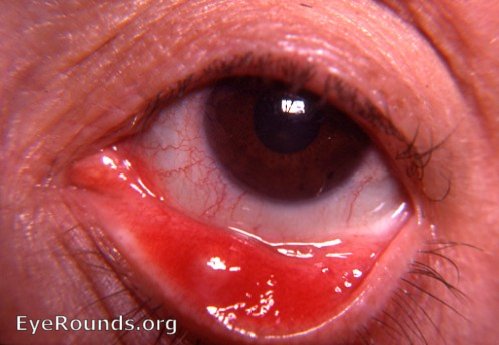 Lid: abscess of meibomian gland ( acute meibomitis/ meibomianitis )