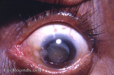 Hypermature Morgagnian cataract with white dots
