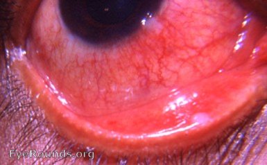 phlyctenular keratoconjunctivitis  