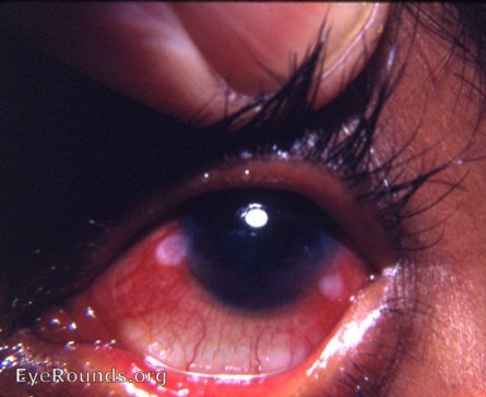 PKC (phlyctenular keratoconjunctivis) : a classic example in a patient at the Eye Clinic in India in 1968.
