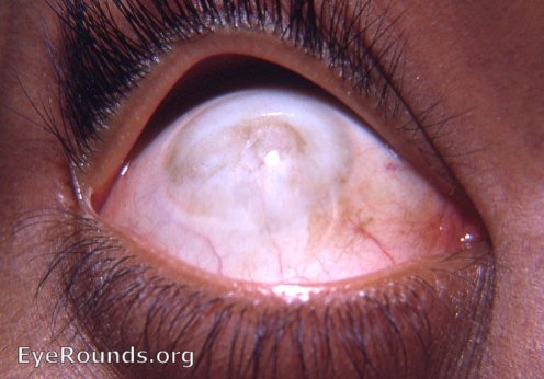 chemical burn: porcelainized scarring of the cornea