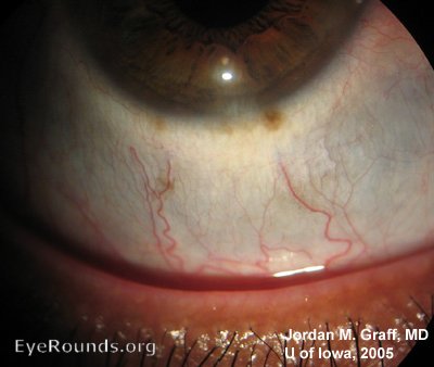close-up of lower eye showing thinning of the sclera