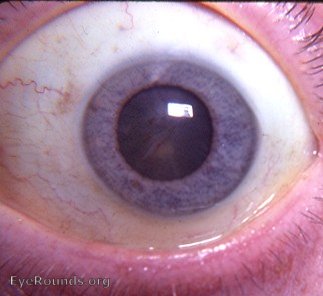 posterior subcapsular cataract 