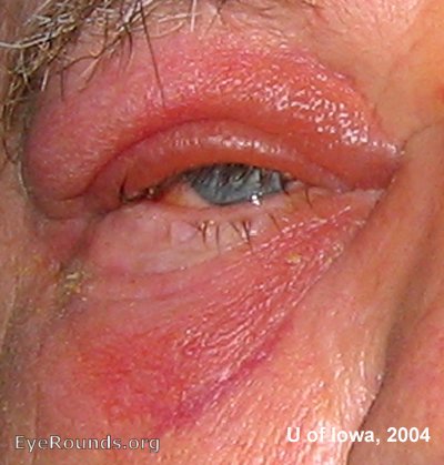 unilateral associated edema in the pre-ocular tissues