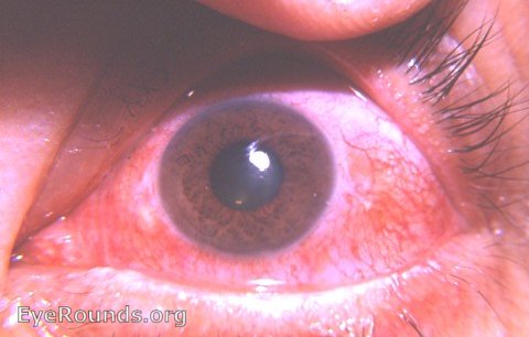 cornea: recurrent corneal abrasion