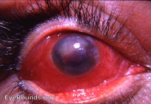 Sympathetic ophthalmia - the exciting eye