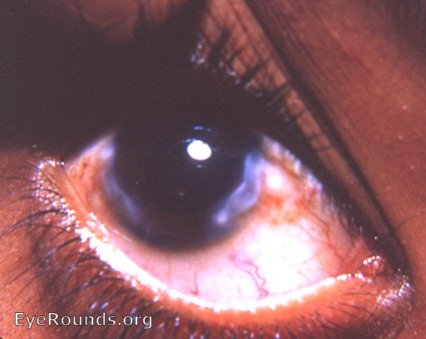 pseudopterygium / Salzmann's nodular corneal degeneration