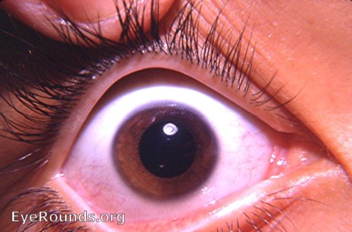 sectorial heterochromia iridis