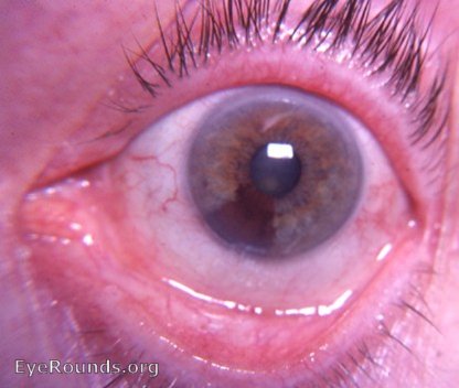 iris nevus: sectorial heterochromia