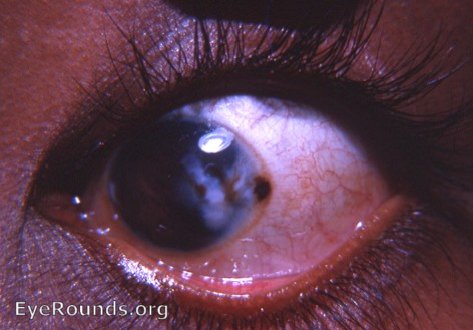 erratic tattoo of corneal leukoma