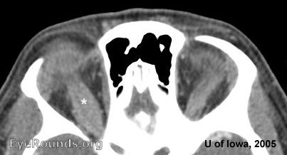 thyroid eye disease Infiltration of the right superior rectus muscle is clearly seen on this CT scan 