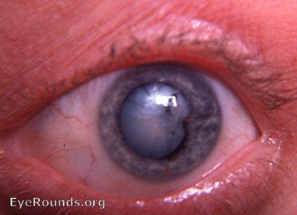 traumatic intumescent cataract with posterior synechia