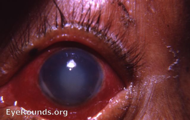 phacolytic glaucoma due to leaking Morgagnian cataract 